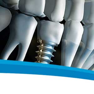 Implante dental