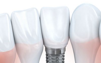 Los implantes dentales