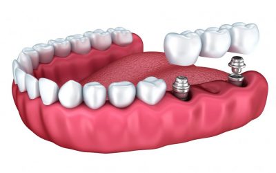 Los implantes dentales son la solución definitiva