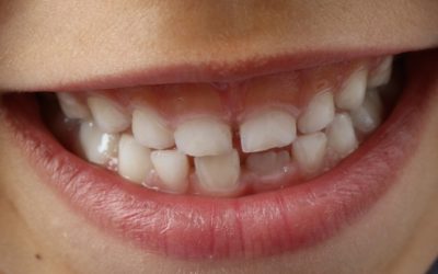 Las caries dentales en los niños