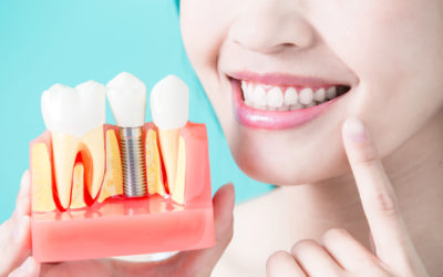 Los implantes dentales arrasan en España