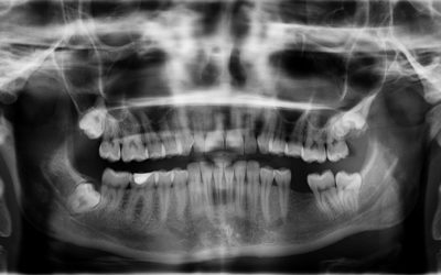 ¿Sabes cuales son la consecuencias de perder un diente?