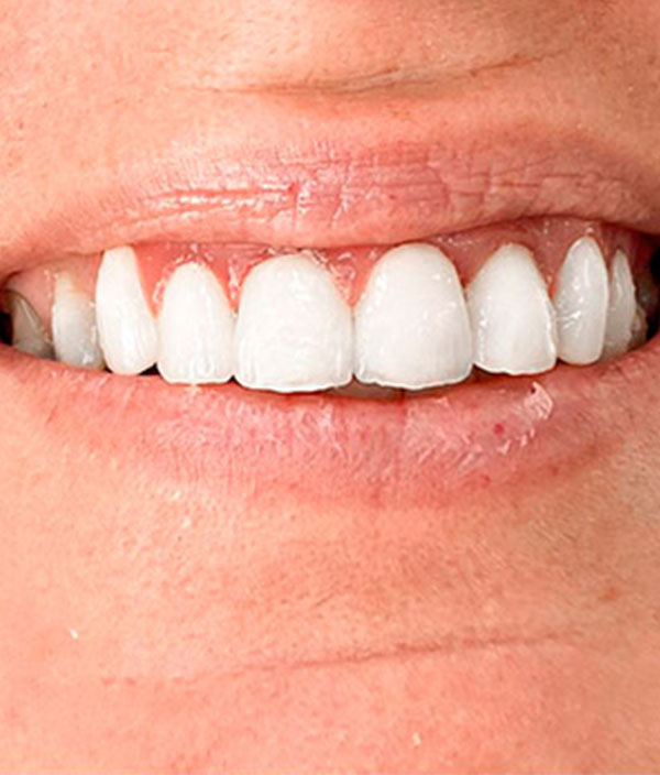 Sustitución dientes sevilla