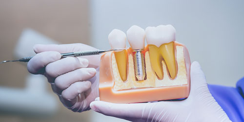Implantes dentales Sevilla