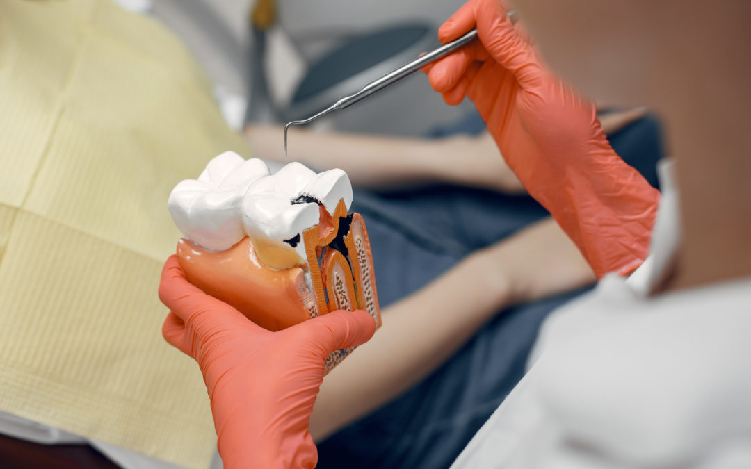 ¿Qué es una endodoncia y cómo tratarla?