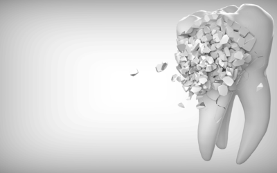 ¿Te han cambiado los dientes sin darte cuenta? Signos silenciosos del desgaste dental